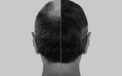 shutterstock 1739791325 1 Blogs 1 The Differences Between Male and Female Hair Restoration