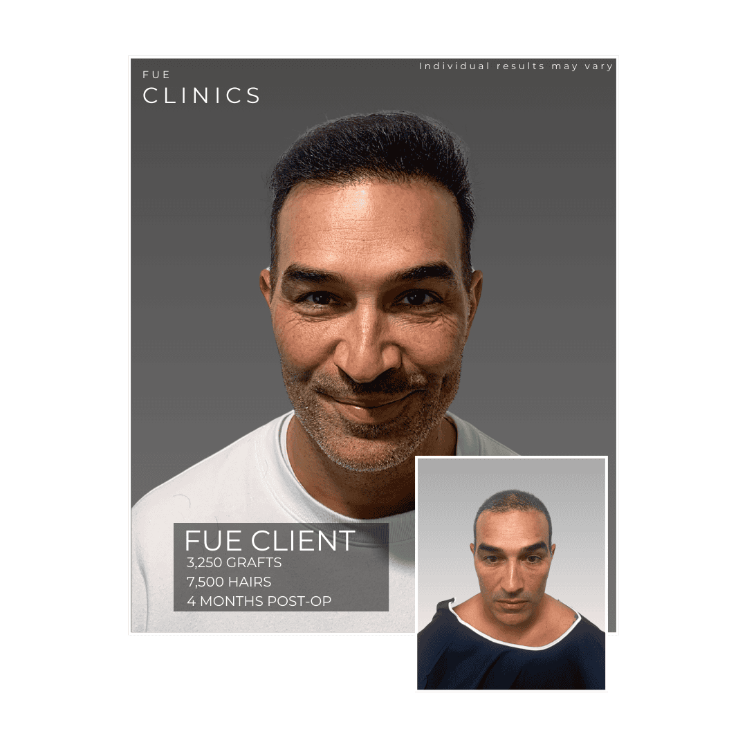 Male Client 1 Hair Restoration 1