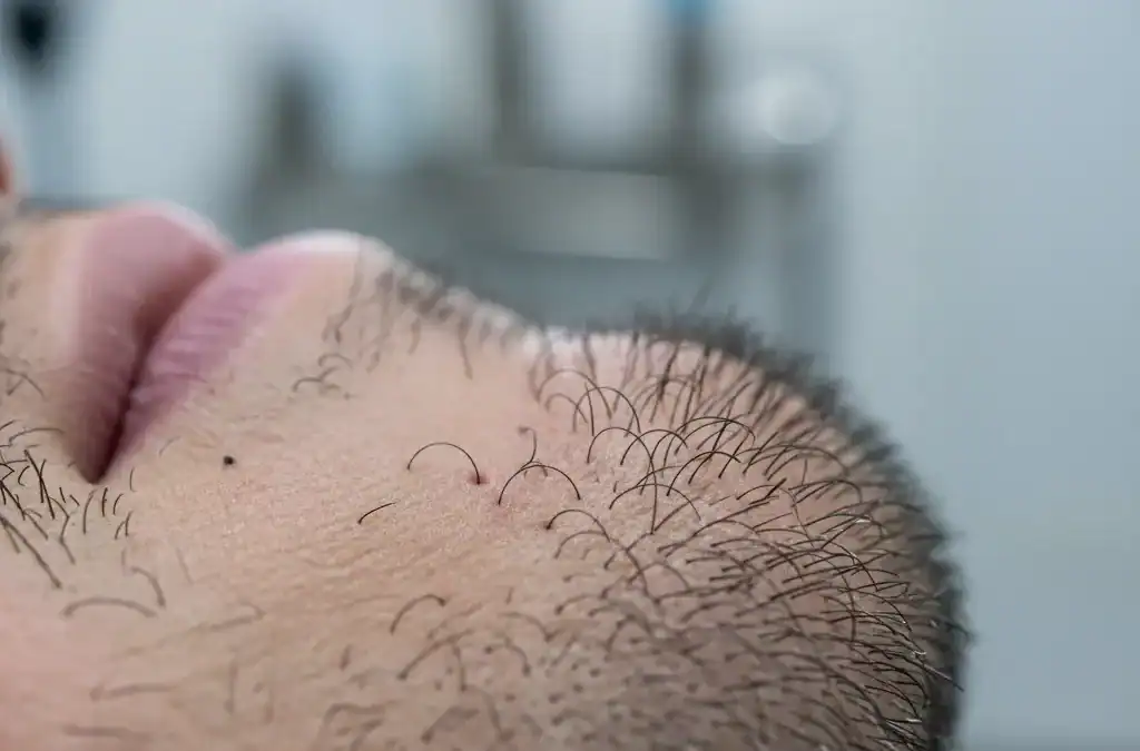 How Much is a Beard Transplant?