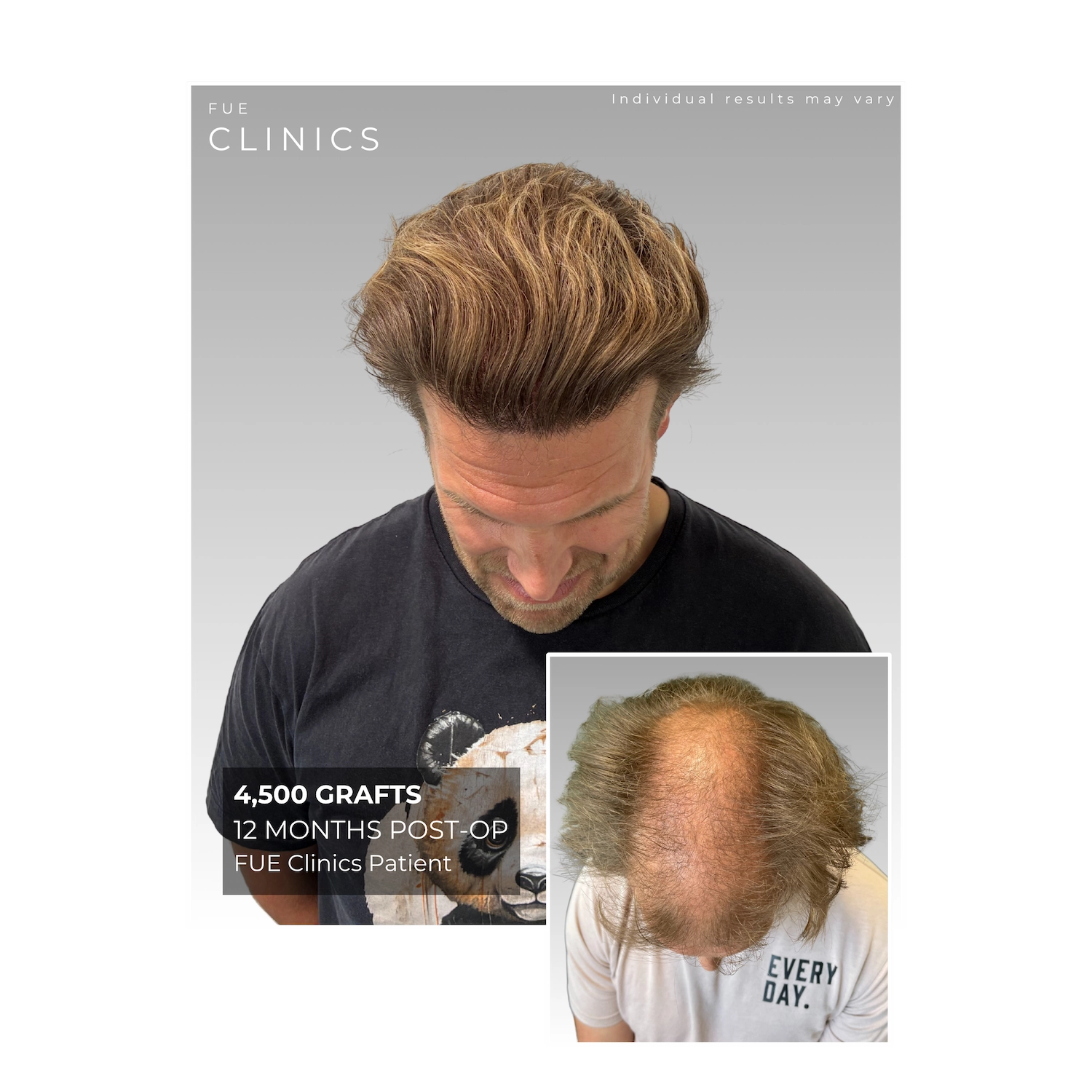 FUE Clinics patient showcasing hair transplant results, 2500 grafts, 12 months post-op. Before and after image demonstrating hair restoration.