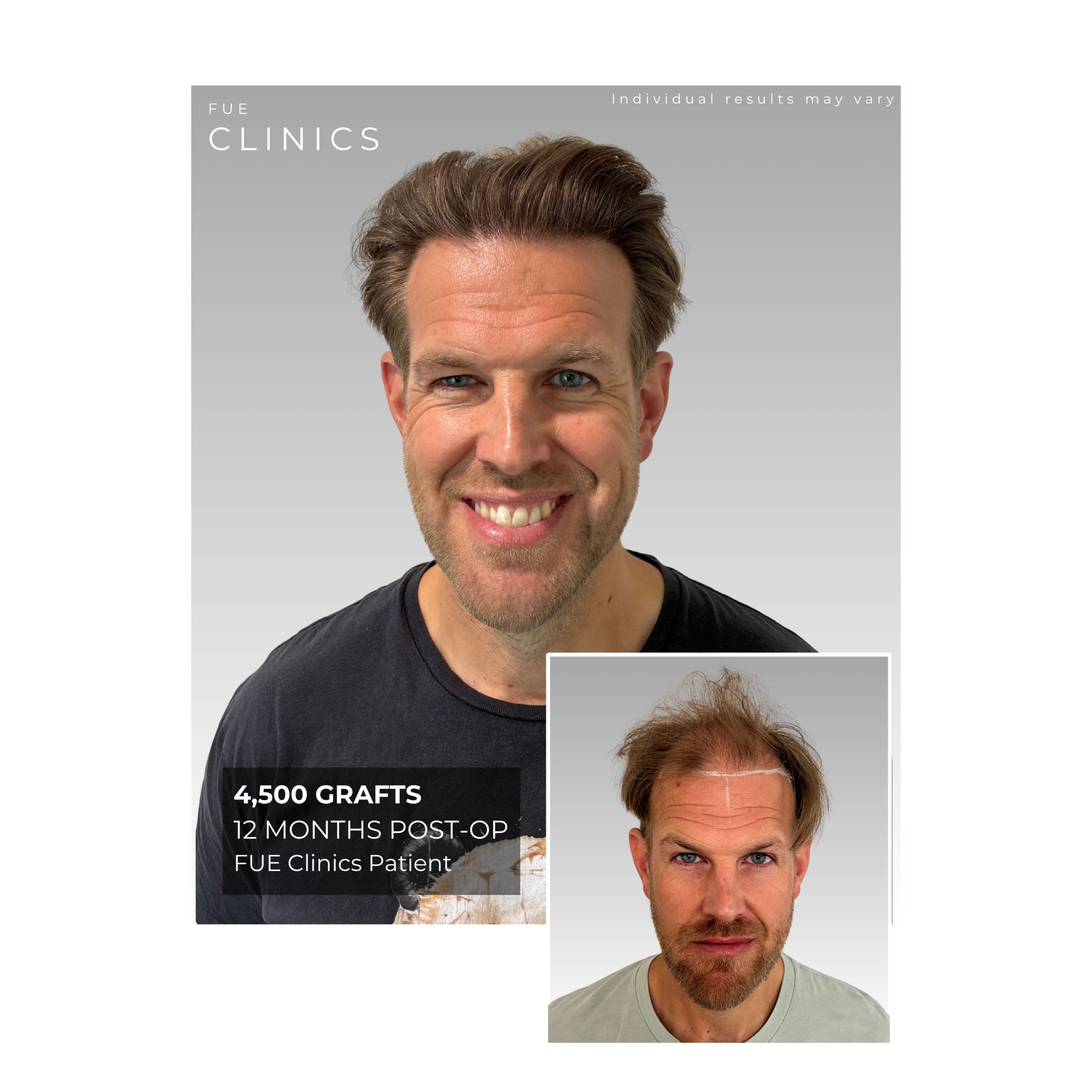 FUE Clinics patient, 3,500 grafts, 6 months post-op. Man with red hair and beard smiles, inset shows before hair transplant. FUE hair restoration.
