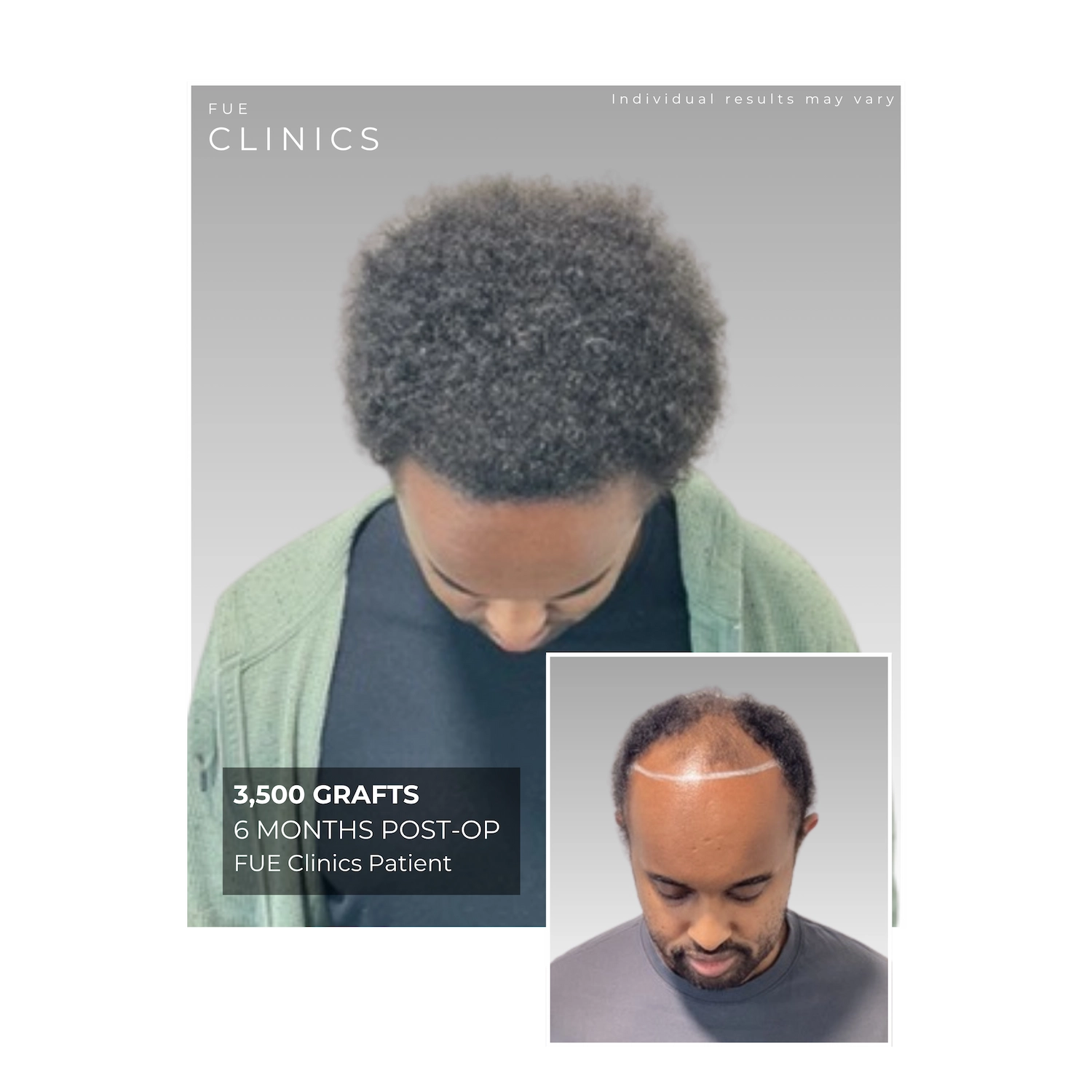 FUE Clinics: Woman's hair transplant before and 12 months after procedure. 2000 grafts. Result of hair restoration with FUE method.