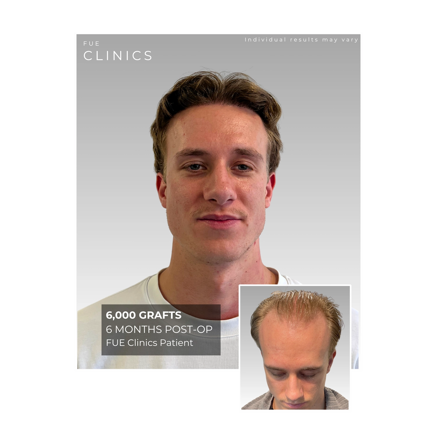 FUE Clinics patient showcasing frontal hairline restoration with 3,300 grafts, 11 months post-op. Before and after hair transplant results.